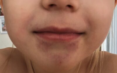 Как заставить кожную сыпь исчезнуть за несколько дней с помощью Магороку